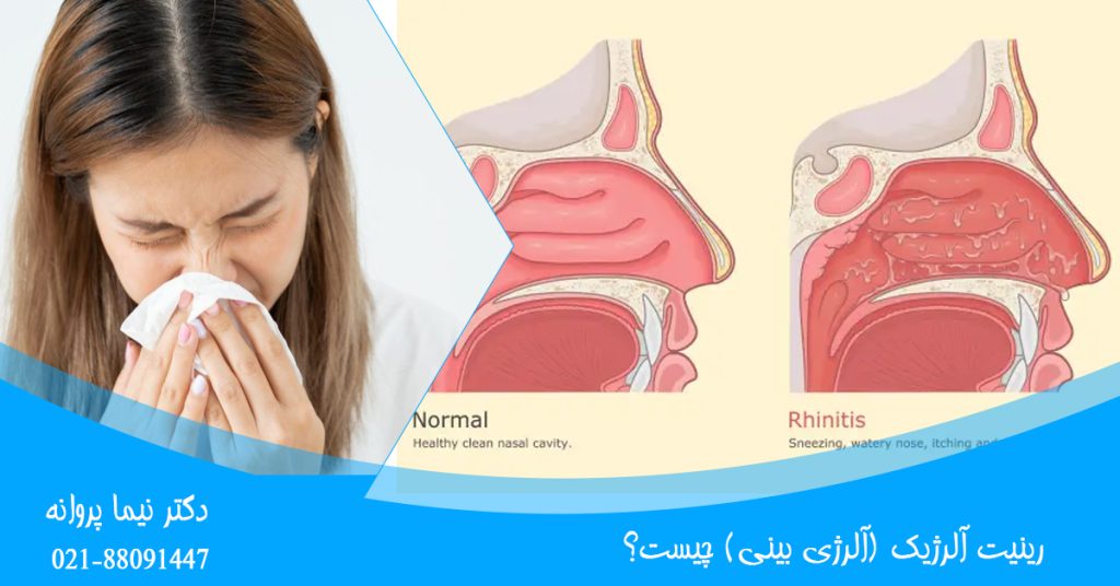 Allergic rhinitis