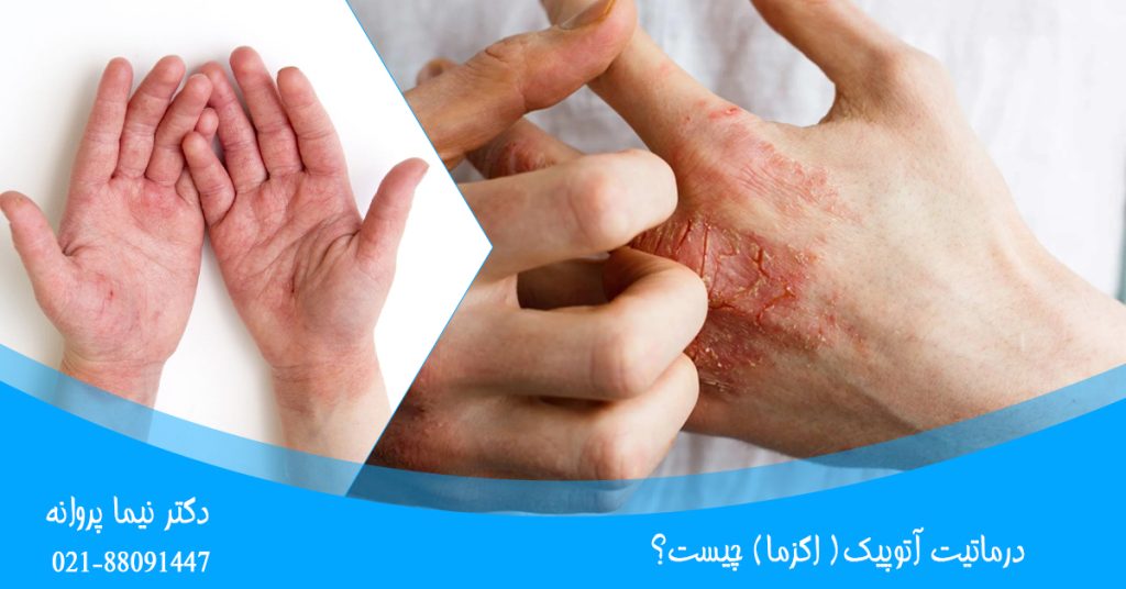 اگزما چیست؟