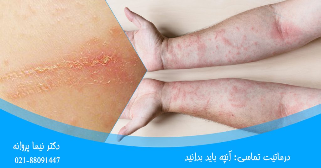 درماتیت تماسی آنچه باید بدانید