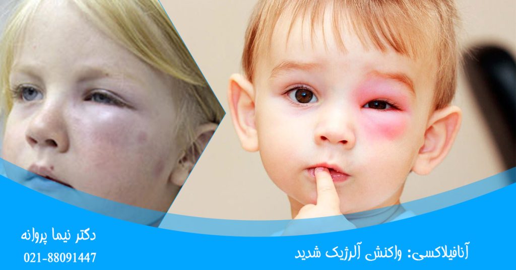 آنافیلاکسی: واکنش آلرژیک شدید