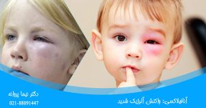 آنافیلاکسی: واکنش آلرژیک شدید