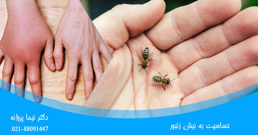 حساسیت به نیش زنبور
