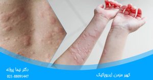 کهیر مزمن ایدیوپاتیک